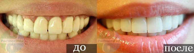К чему снится снимать коронки с зуба К чему снится снимать коронки с зуба