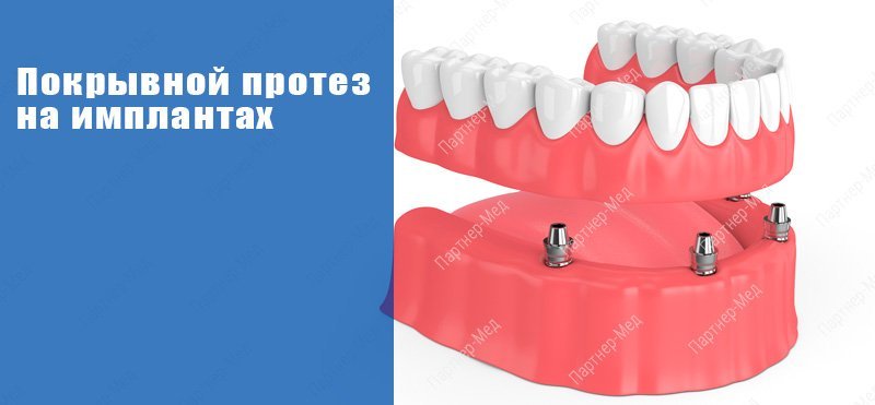полный покрывной зубной протез на импланта