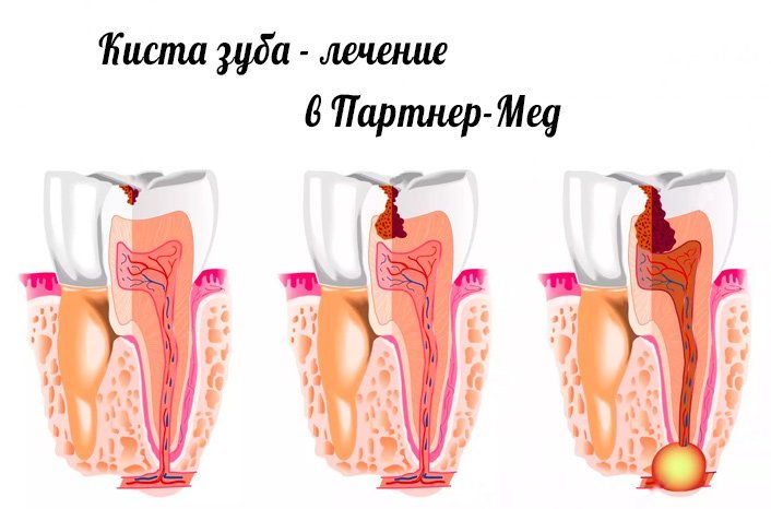 образование кисты