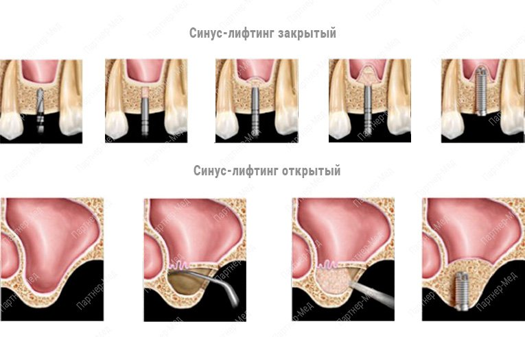 синус лифтинг