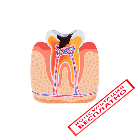 Лечение пульпита у детей