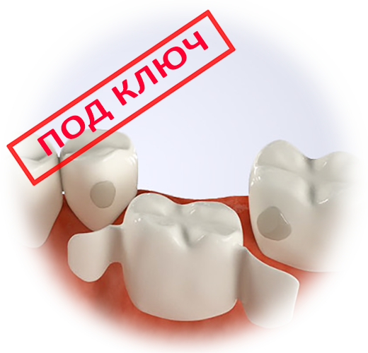 Прямое протезирование без обтачивания соседних зубов - Альтенхофф
