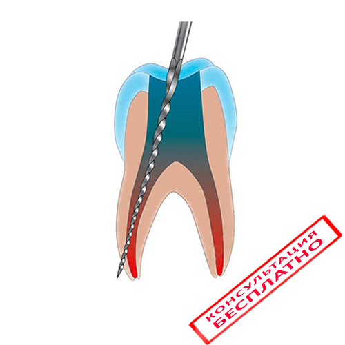 Лечение корневых каналов (пульпит, периодонтит)