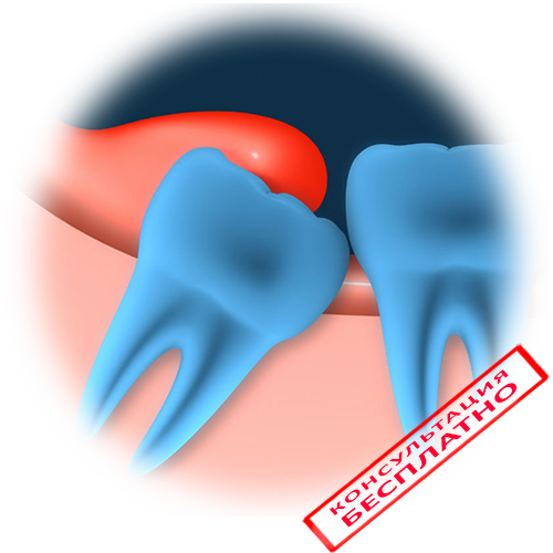 Иссечение капюшона над зубом мудрости (лечение перикоронита) в Москве | Цены в стоматологии