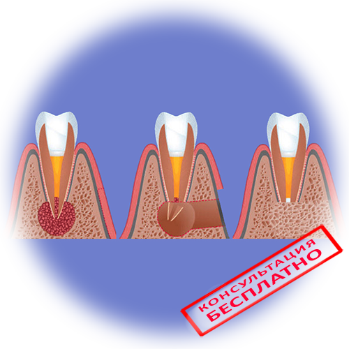 Гранулема зуба - симптомы и лечение