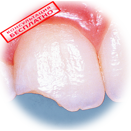 Откололся кусочек зуба (переднего, жевательного) – что делать при сколе зуба