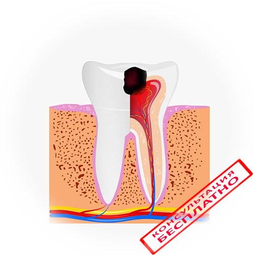 Пульпит Зуба Лечение Цена