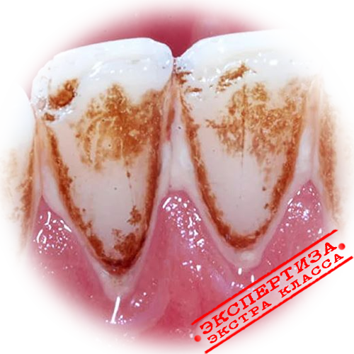 Удаление зубного налета в домашних условиях - полезные статьи от стоматологии SDent