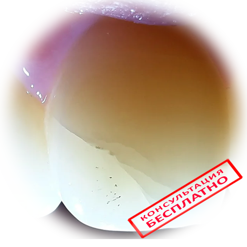 Опасен ли клиновидный дефект зуба