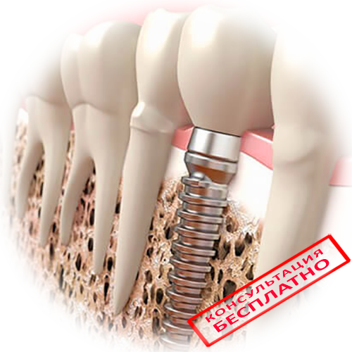 Больно ли ставить импланты зубов – ответ имплантолога