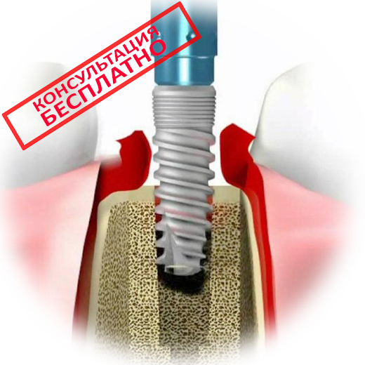 Больно ли ставить импланты: все о процедуре протезирования зубов