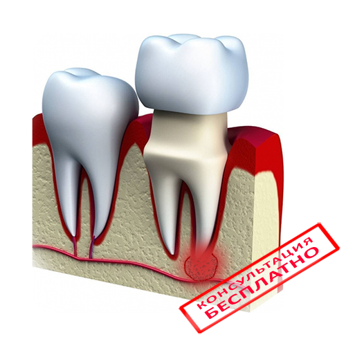 Киста корня зуба, чем опасна и как лечить? - Стоматологический блог PRIMED