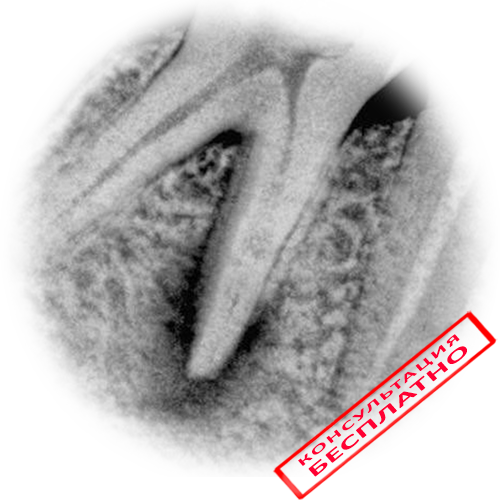Как лечат воспаление корня зуба без удаления