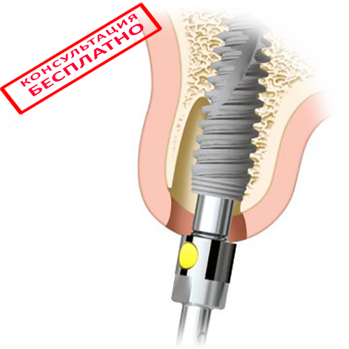 Онемение после имплантации зубов - Стоматология «НоваДэнт»