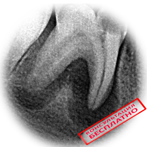 Периодонтит 3 канального зуба