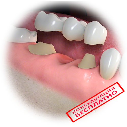 Варианты восстановления зубов