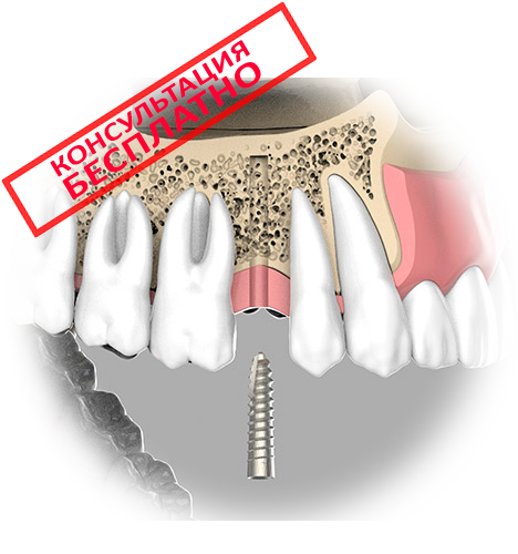 Наращивание кости зуба. Наращивание костной ткани для имплантов. Наращивание кости для импланта. Наращивание костной ткани десны. Наращивание костной ткани в стоматологии.