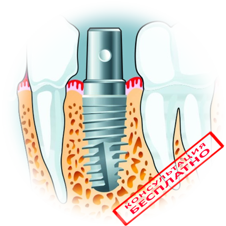 Как лечить свищ или шишку на десне? | Стоматология DentArt | Киев