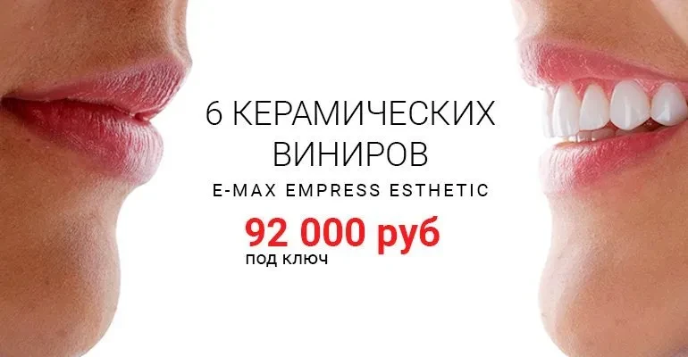 Что лучше коронки или виниры?