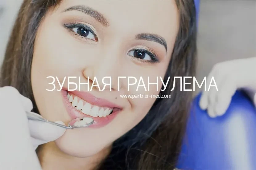 Гранулема зуба: удаление и методы лечения