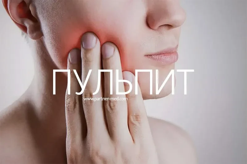Пульпит зуба