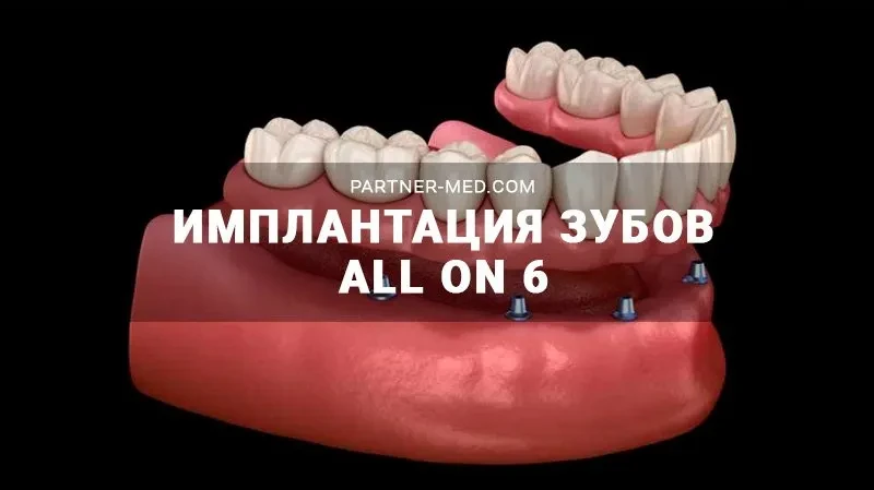 Имплантация All-on-6 Имплантация All-on-6