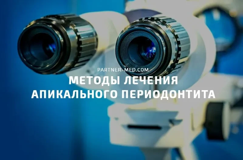 Методы лечения апикального периодонтита