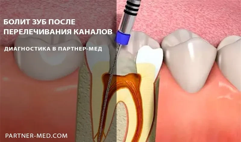 Появились боли после перелечивания каналов зуба