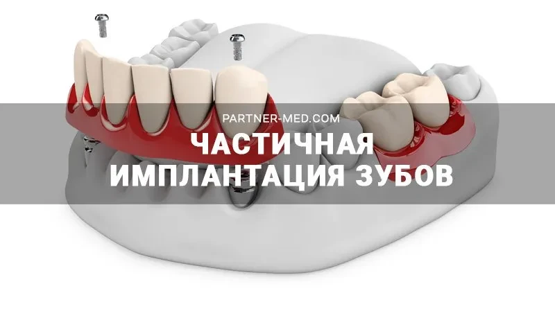 Частичная имплантация зубов Частичная имплантация зубов