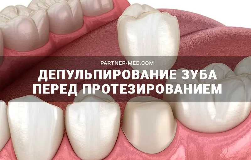 Депульпирование зуба перед протезированием
