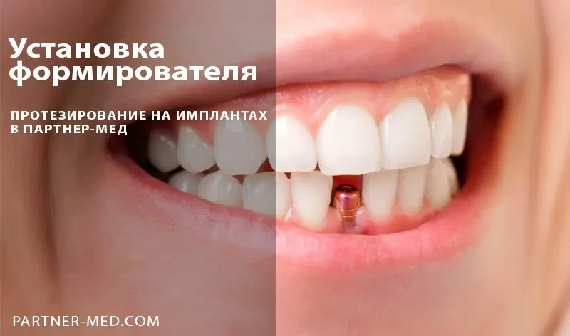 Установка формирователя десны на имплант Установка формирователя десны на имплант