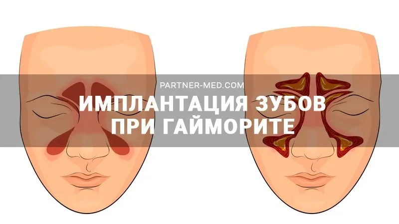 Имплантация зубов при гайморите Имплантация зубов при гайморите