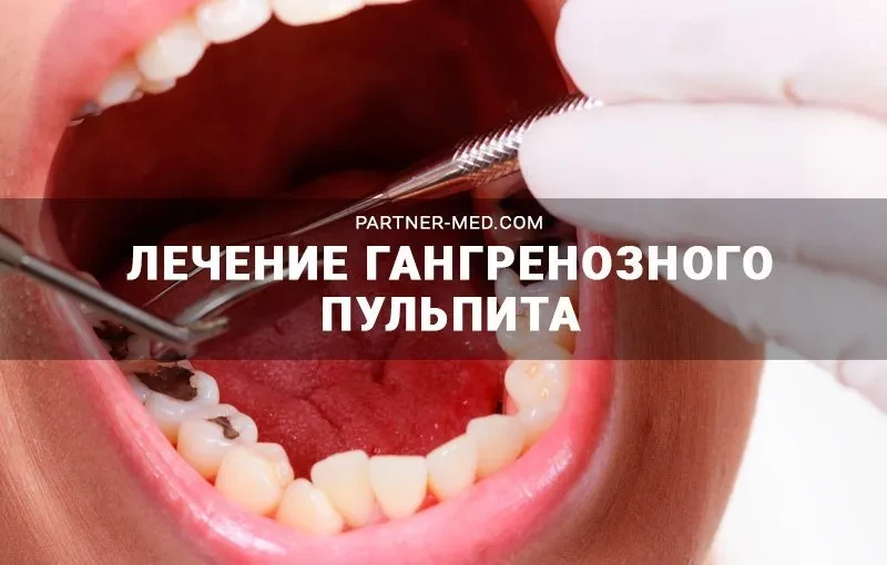 Лечение гангренозного пульпита