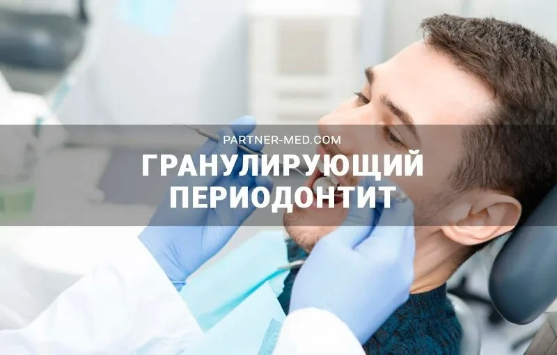 Лечение гранулирующего периодонтита