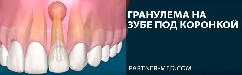 Гранулема корня зуба под коронкой
