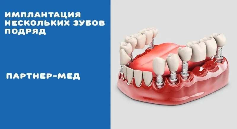 Имплантация нескольких зубов подряд Имплантация нескольких зубов подряд