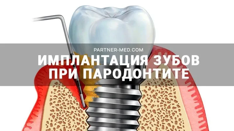 Имплантация зубов при пародонтите Имплантация зубов при пародонтите