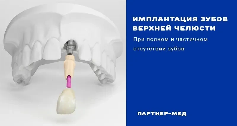 Имплантация зубов верхней челюсти Имплантация зубов верхней челюсти