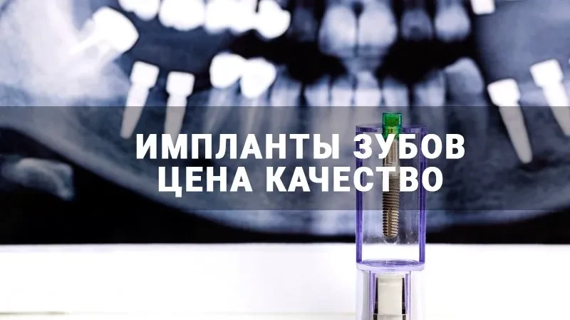 Как выбрать импланты зубов по цене и качеству? Как выбрать импланты зубов по цене и качеству?