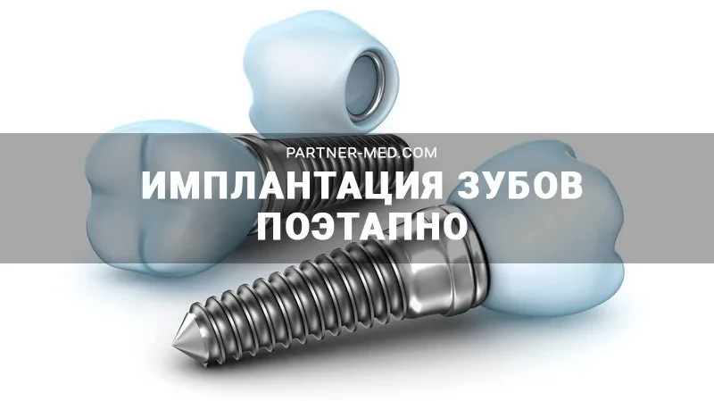 Имплантация зубов поэтапно Имплантация зубов поэтапно