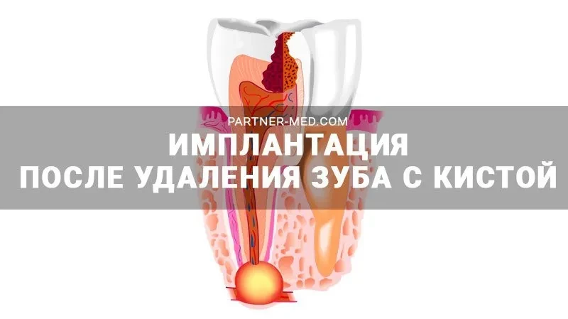 Установка импланта после удаления зуба с кистой Установка импланта после удаления зуба с кистой
