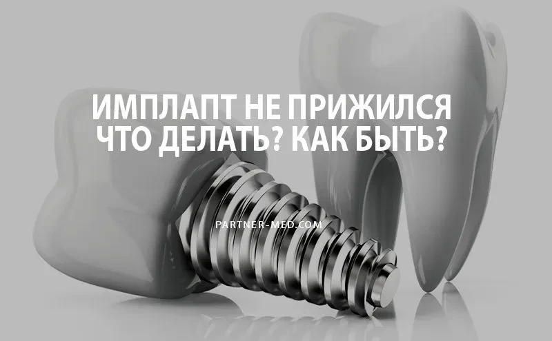 Что делать, если имплант зуба не прижился? Что делать, если имплант зуба не прижился?