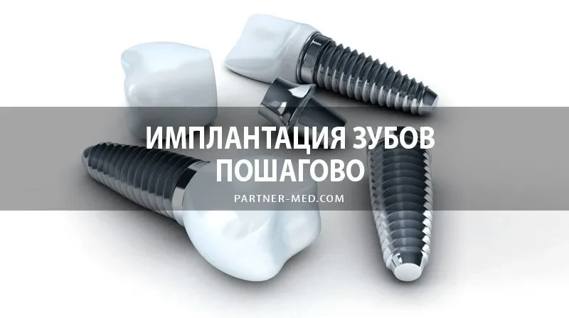 Имплантация зубов пошагово