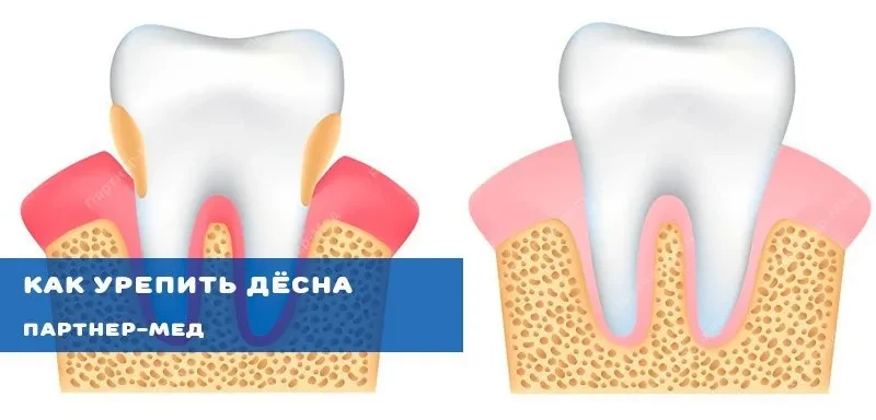 Устраняем кровоточивость и рыхлость дёсен