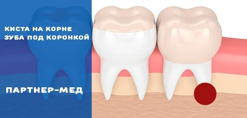 Киста на корне зуба под зубной коронкой