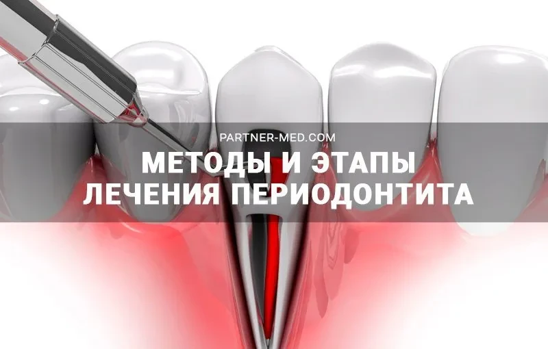 Методы и этапы лечения периодонтита зуба