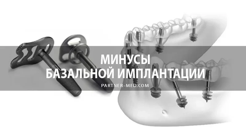 Минусы и недостатки базальной имплантации Минусы и недостатки базальной имплантации