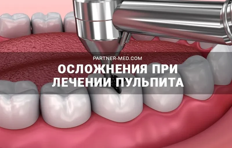 Осложнения при лечении пульпита