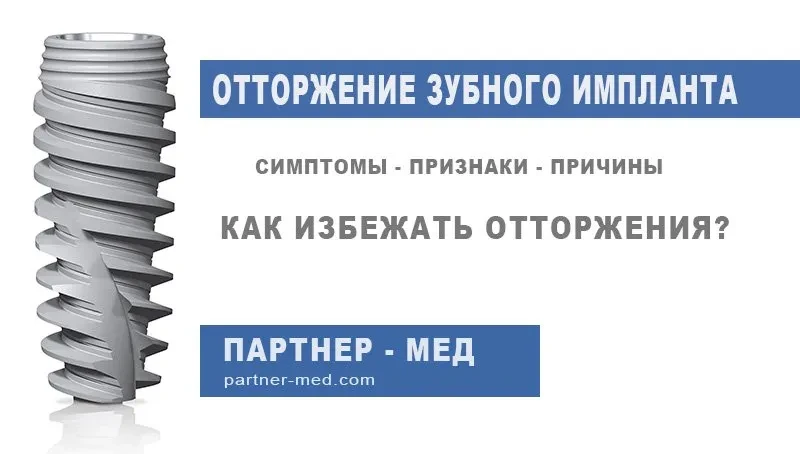Отторжение зубного импланта Отторжение зубного импланта