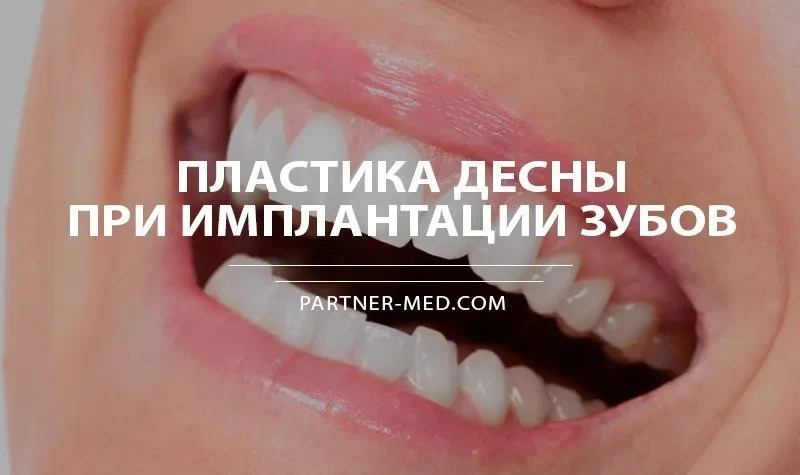 Пластика десны при имплантации зубов Пластика десны при имплантации зубов